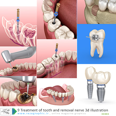 ۹ Treatment of tooth and removal nerve 3d illustration ( www.rezagraphic.ir )